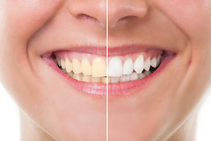 Teeth Whitening in Philadelphia